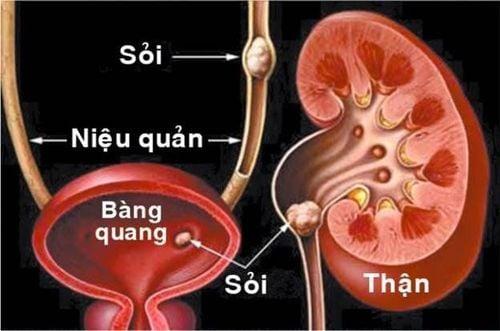 Sỏi thận và các dị vật đường tiết niệu có thể là nguyên nhân gây đi tiểu nhiều lần trong ngày