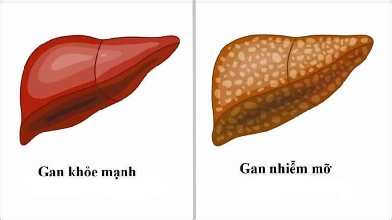 Gan nhiễm mỡ là tình trạng tích tụ quá nhiều chất béo trong gan